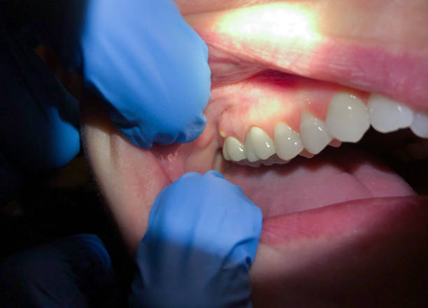 Best Emergency Dentist for Knocked-Out Tooth in Factoryville, PA